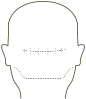 Scalp Micropigmentation Hairline Dallas