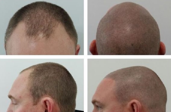 Hairline Scalp Micropigmentation Hairline Scalp Micropigmentation