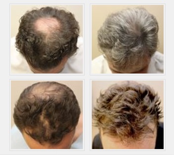 Micropigmentation Pattern Balding - Before & After
